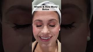 Where and How Many Botox Injection Did I Get in Total? Customized to your muscles!