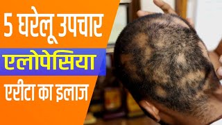 5 Home Remedies for Alopecia Areata! Treatment of Alopecia Areata!