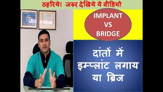 Dental Implant vs Bridge