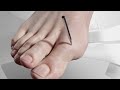 Minimally Invasive Hallux Valgus Bunion Surgery