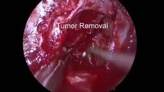 เนื้องอกต่อมใต้สมอง #ตามัว #ผ่าตัดส่องกล้องเนื้องอกต่อมใต้สมอง Endoscopic Pituitary Tumor Surgery