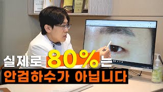 (눈성형) 당신의 눈은 ㅣ안검하수ㅣ가 확실합니까?(ENG)