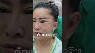 สาเหตุที่อ้อย กะท้อน มาดึงหน้า #parinclinic #facelift #shorts