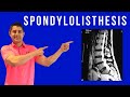 Spondylolisthesis Cause, Symptoms and treatment for pain relief