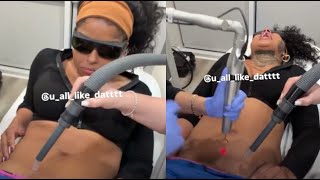 "Get It Off" Chrisean Laser Removes The Last Blueface Tattoo On Her Juice Box