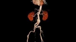 irad-ka CT 3D aorta aneurysma Radiologie Karlsruhe