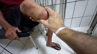 Dor no coto - Avaliação sugestão para diminuir as dores #fisioterapia #amputee #pain