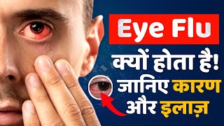 Eye Flu Treatment In Hindi | Eye Flu Hone Par Kya Karen | Conjunctivitis treatment