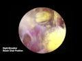 Arthroscopic Suprascapular Nerve Release