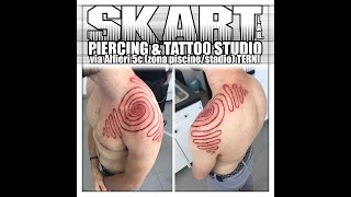 Cutting scarification procedure - SKART Lab. TERNI