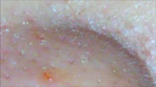 柔らか角栓　limp blackhead 【閲覧注意】