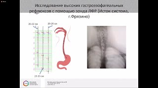 Валитова Э.Р. Особенности диагностики ларингофарингеальных рефлюксов