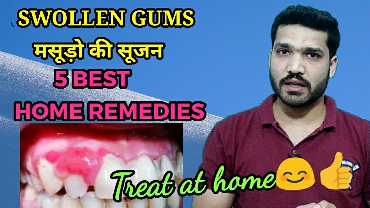 मसूड़ो की सूजन 5 घरेलू इलाज | 5 Best Home Remedies For Swollen Gums ...