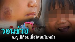 วอนช่วยเหลือ ด.ญ.5 ขวบ มีก้อนเนื้อบนใบหน้า | แคนช่วยได้ | ข่าวช่องวัน | one31