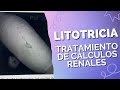 Cálculos renales. Litotricia | Dr. Luis Susaníbar. Urólogo y Andrólogo.