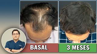 ¿Alopecia androgenética? Este paciente recuperó su cabello, ¡mira cómo!