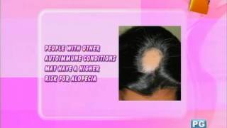 Doctors On TV: Alopecia Areata or Hair Loss