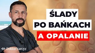 Czy można opalać ślady po bańkach?