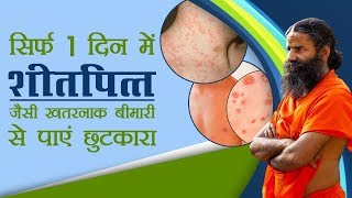 सिर्फ 1 दिन में Urticaria (शीतपित्‍त) जैसी खतरनाक बीमारी से पाए छुटकारा | Swami Ramdev