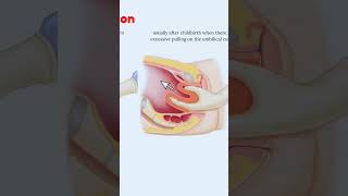 Uterine Inversion 🥺#uterus #shortsvideo #share