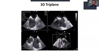 Evaluation of atrial septal defects and guidance for transcatheter closure