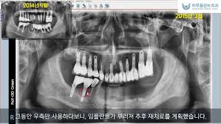 [임플란트] 타치과 임플란트 재시술, 타치과 임플란트 재수술, 임플란트 부작용 재치료