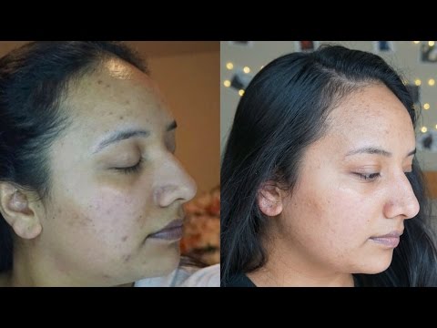 How to get rid of acne scars | Skincare routine | Retin-a How to get rid of acne scars | Skincare routine | Retin-a
