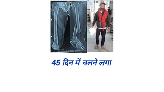 फीमर बोन फ्रैक्चर 45 दिन मे चलने लगा। Recovery update after 45 days femur bone fracture