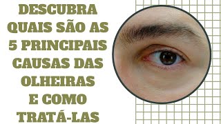 Descubra quais são as 5 principais causas de olheiras e como tratá-las