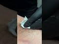 ARMPIT CYST!