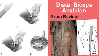 Distal Biceps Avulsion Exam Review - Christopher S. Ahmad, MD