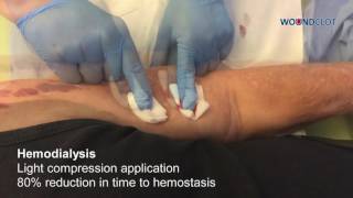 WoundClot - Hemodialysis Bleeding Control