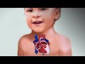 Surgical Palliation for Single Ventricle Lesions | OPENPediatrics