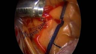 In-Bag Morcellation with LIMAS MORCELLATOR 10mm (REUSABLE) And Limas Safety Isolation Bag