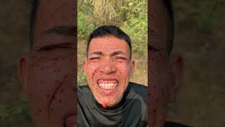 I Treated My Acne with Forest Remedies – Extreme Survival Experiment