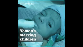 Yemen’s starving children, a grim legacy of war