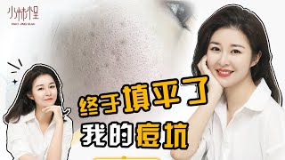 痘坑痘印痘疤如何修復和消除？十幾年的長痘爛臉史的我是如何填痘坑的？❤️酒醉小精怪