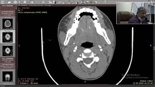 Case 1 - International Endoscopic Sinus and Skull Base Surgery - Dr Satish Jain