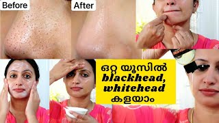 ഒറ്റ യൂസിൽ blackheads,Whiteheads കളയാം/How to remove blackheads/whiteheads easily at home.