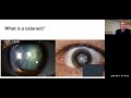 2020-09-11 UofT DOVS Grand Rounds - The Debaters -  What is a cataract?