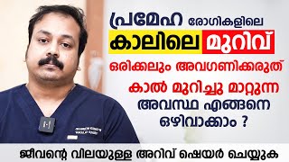 പ്രമേഹ രോഗികളിലെ കാലിലെ മുറിവ് ഒരിക്കലും അവഗണിക്കരുത് | Diabetic Foot Malayalam | Dr. Vineeth Kumar