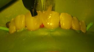 Closing Spaces Between Front Teeth - Bioclear Technique