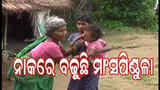 ଅସ୍ୱାଭାବିକ ଭାବେ ନାକରେ ବଢୁଛି ମାଂସ ପିଣ୍ଡୁଳା