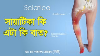 Sciatica/ সায়াটিকা কি; এটা কি বাত...