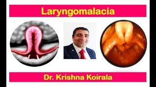 Laryngomalacia // Congenital laryngeal disorders  // Dr. Krishna's ENT Lectures  // ENT