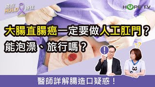 大腸直腸癌一定要做人工肛門嗎？做完能泡澡、出國旅行嗎？醫師詳解腸造口疑惑！｜ft.臺北醫學大學附設醫院血液腫瘤科謝政毅醫師｜【癌症HOLD得住】