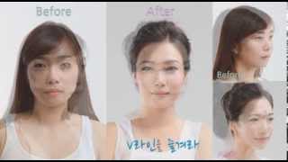 ☆강남역 성형 대표 브랜드 [로미안성형외과]-plastic surgery