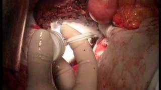 PerClot Liver Surgery