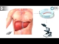 how to diagnose and manage alcohol related liver disease dr. tejeswi s gutti