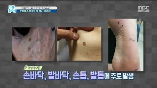 [HEALTH] fingernail,claws \u0026 footpad moles , 기분 좋은 날 20191002